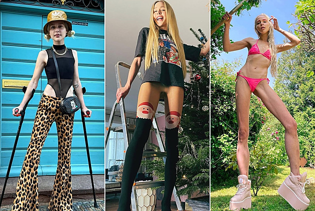 Žena si nechala prodloužit nohy o čtrnáct centimetrů, chtěla být vyšší