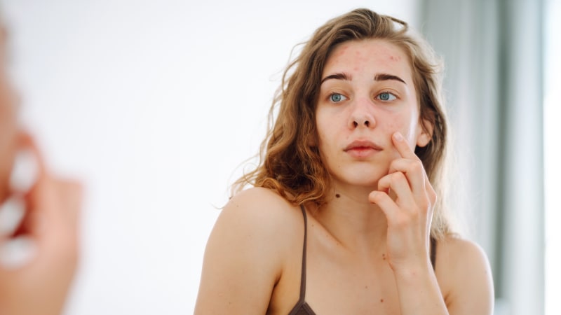 Z pultů musí čtveřice léků. Je mezi nimi i roztok na akné, SÚKL zjistil pochybení ve výrobě