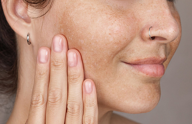Tmavé skvrny na pleti? Dermatolog vysvětluje, proč vznikají a jak je zmírnit